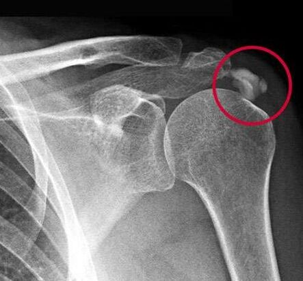 The X-ray showed deposits of calcium salts in the joint