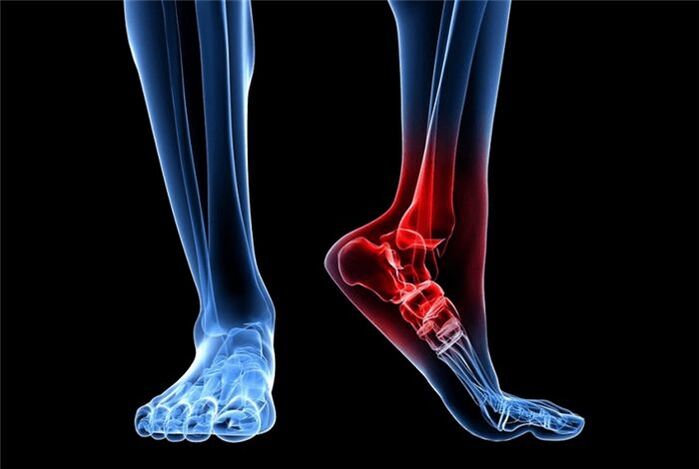 arthrosis of the foot