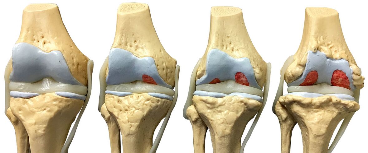 The arthrosis stages of the knee joint