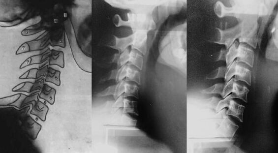 Neck with the first cervical vertebra