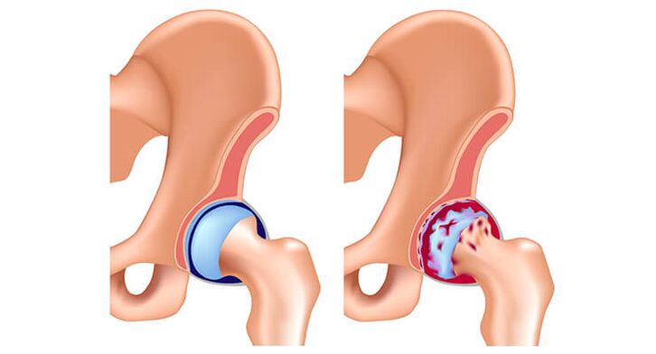 The hip joint is a joint joint